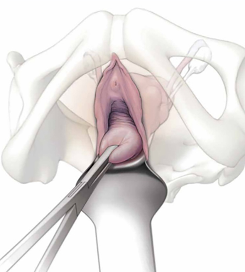 Side effects of Vaginal Hysterectomy