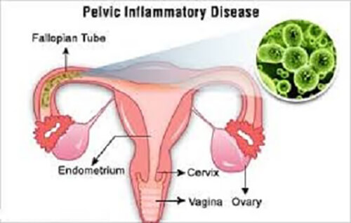 inflammation to pelvic organs