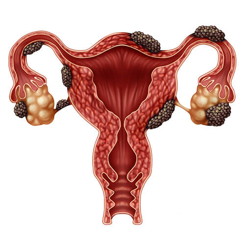 Endometriosis condition