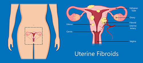 Fibroid growth causes tumour