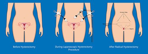 outcome of hysterectomy surgery