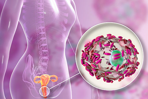 Bacterial Vaginosis in a female's vagina