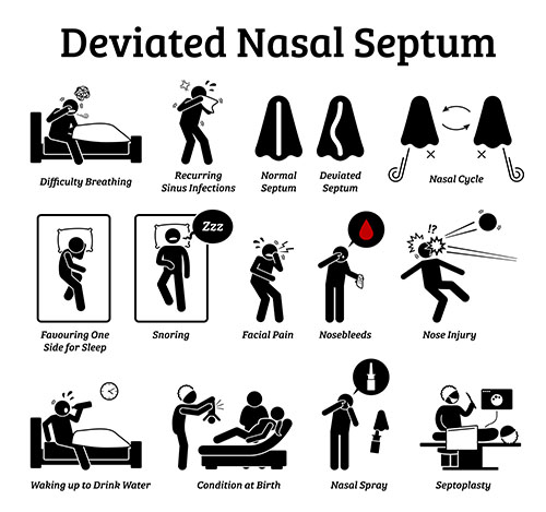 a pictorial representation of symptoms and treatments of deviated septum