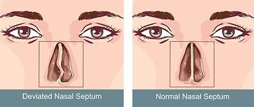 Difference between normal and deviated nasal septum