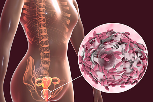 Bacterial Vaginosis