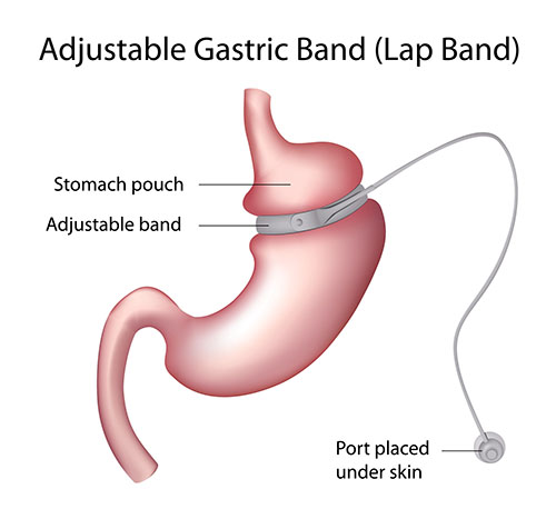 Know more about Gastric surgery