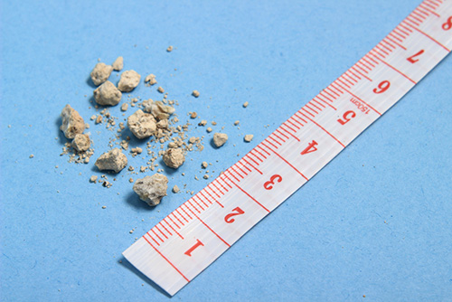 struvite stones in kidney