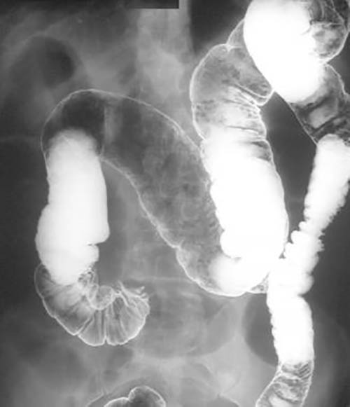 X-Ray indicating presence of bowel obstruction
