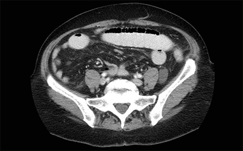 barium enema