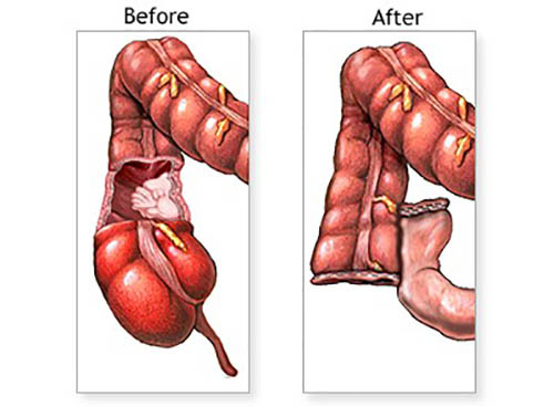bowel resection
