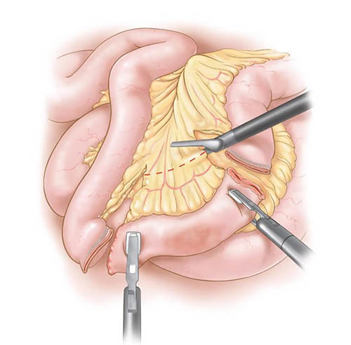 Large Bowel Resection