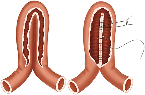 bowel strictureplasty