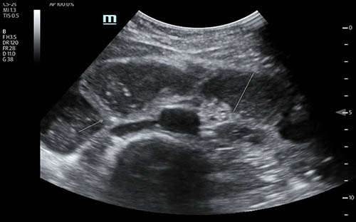 ultrasound of intestine