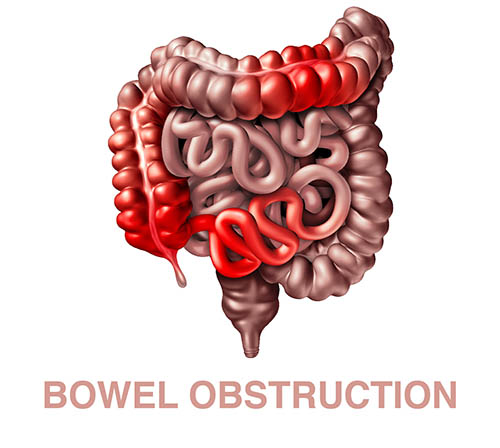 cause of bowel obstruction