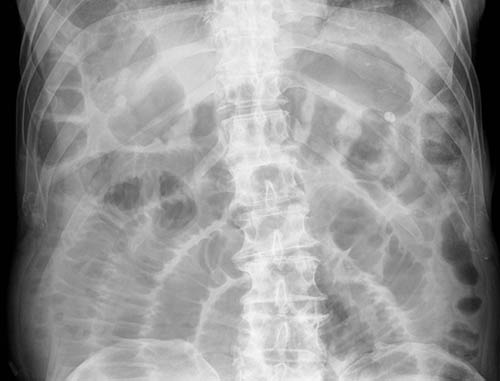x ray in bowel obstruction