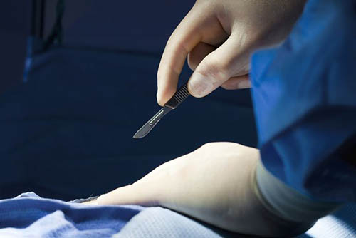 bowel obstruction laser surgery