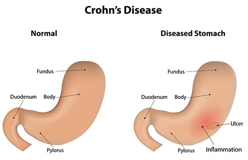 Defect Crohn's disease