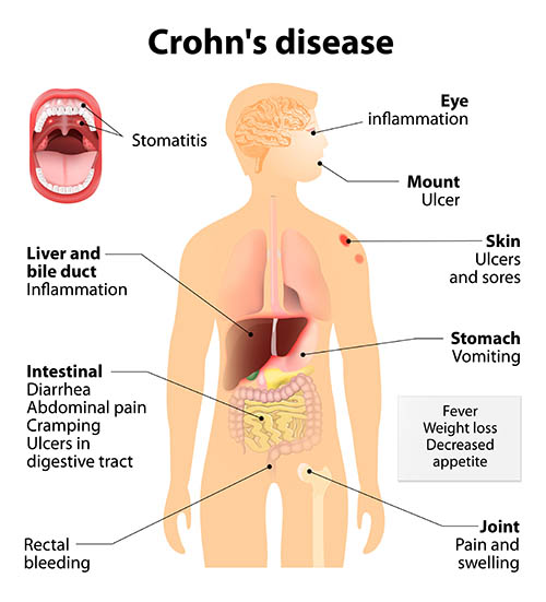 Crohn's affecting GI