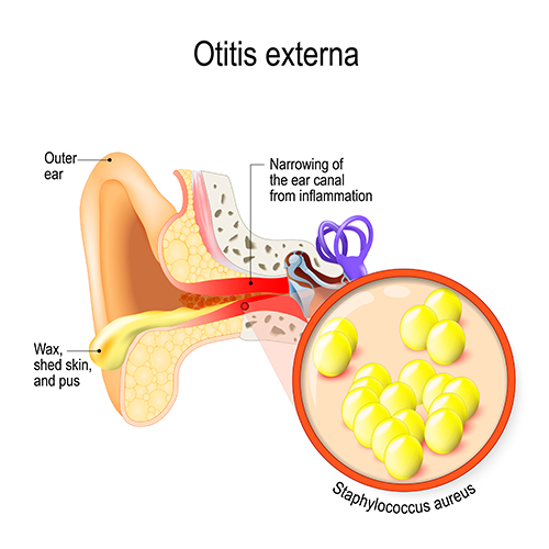 outer ear infection - swimmers ear infection -ear anatomy