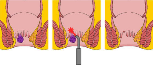 portraying a close image of a laser fissure treatment