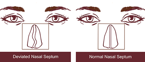 Deviated nasal septum