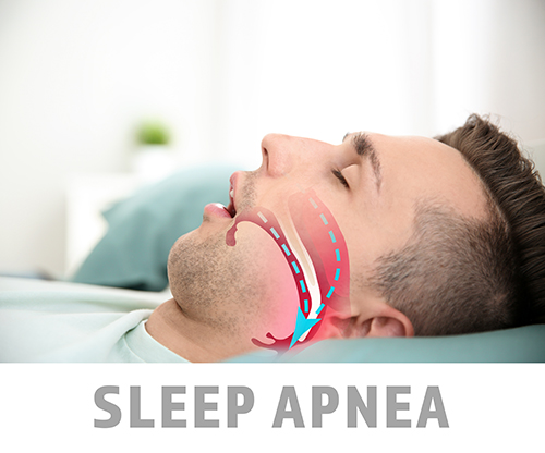 Obstructive Sleep Apnea 
