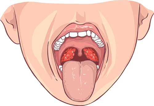 Tonsil or adenoid infection