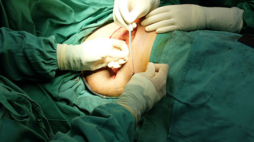 mastectomy recovery process