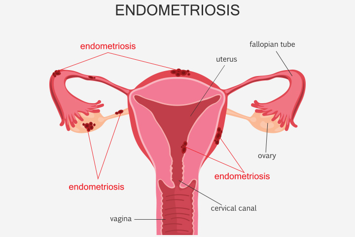 Endometriosis