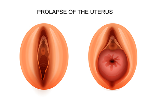 prolapse