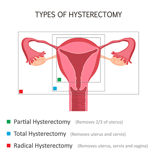 Types of hysterectomies