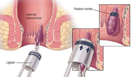 kinds of Piles surgery