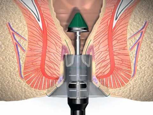 painless Piles Surgery