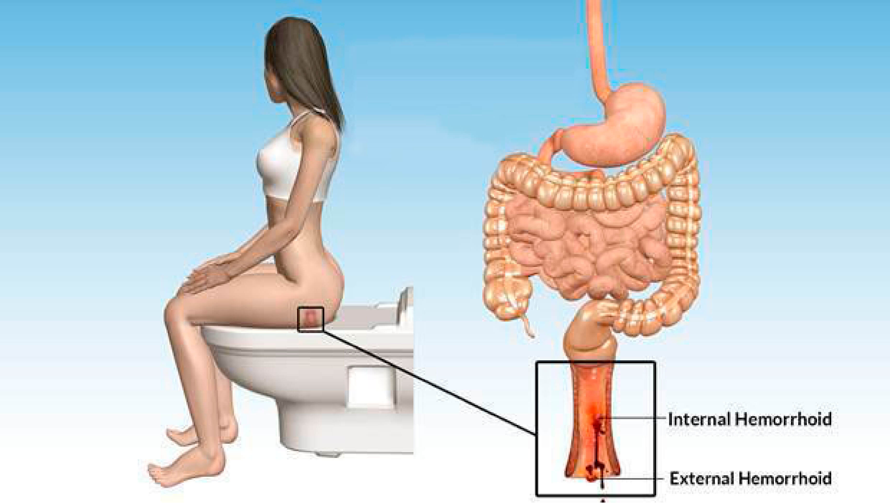 bleeding from hemorrhoids while passing stool