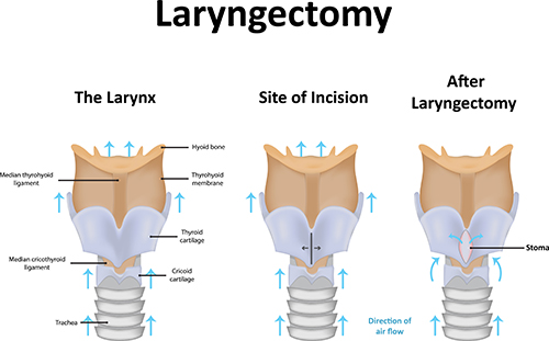 Life analysis after laryngectomy