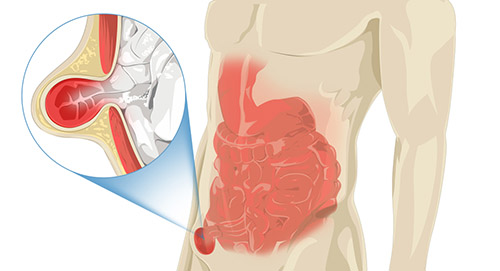 Inguinal hernia