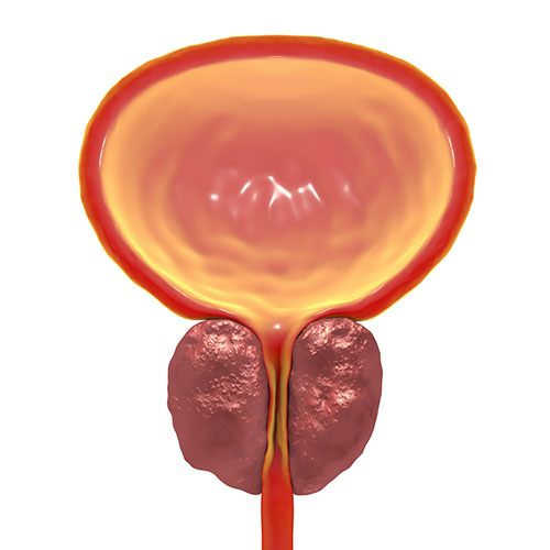 enlarged prostate treatment