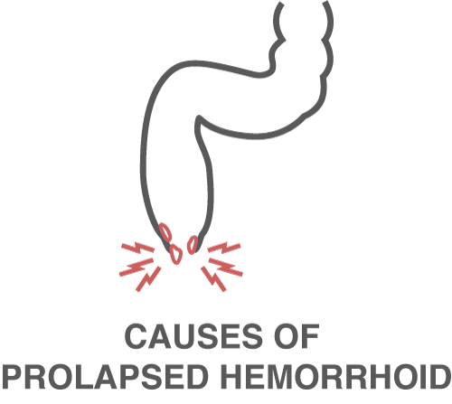 causes of prolapsed piles