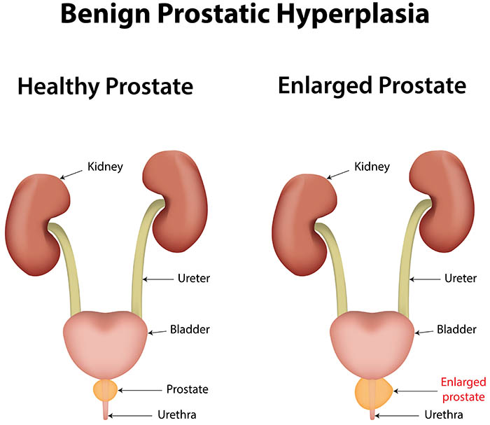 prevention of bph