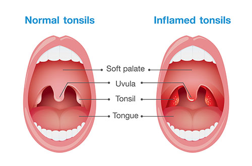 comparison between normal and inflamed tonsils?