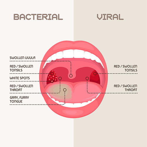 difference in conditions from virus and bacteria