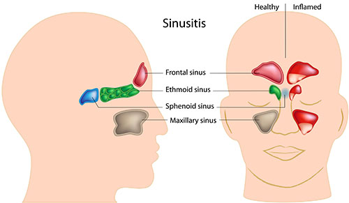image showing all types of sinuses in the nasal cavity and frontal head