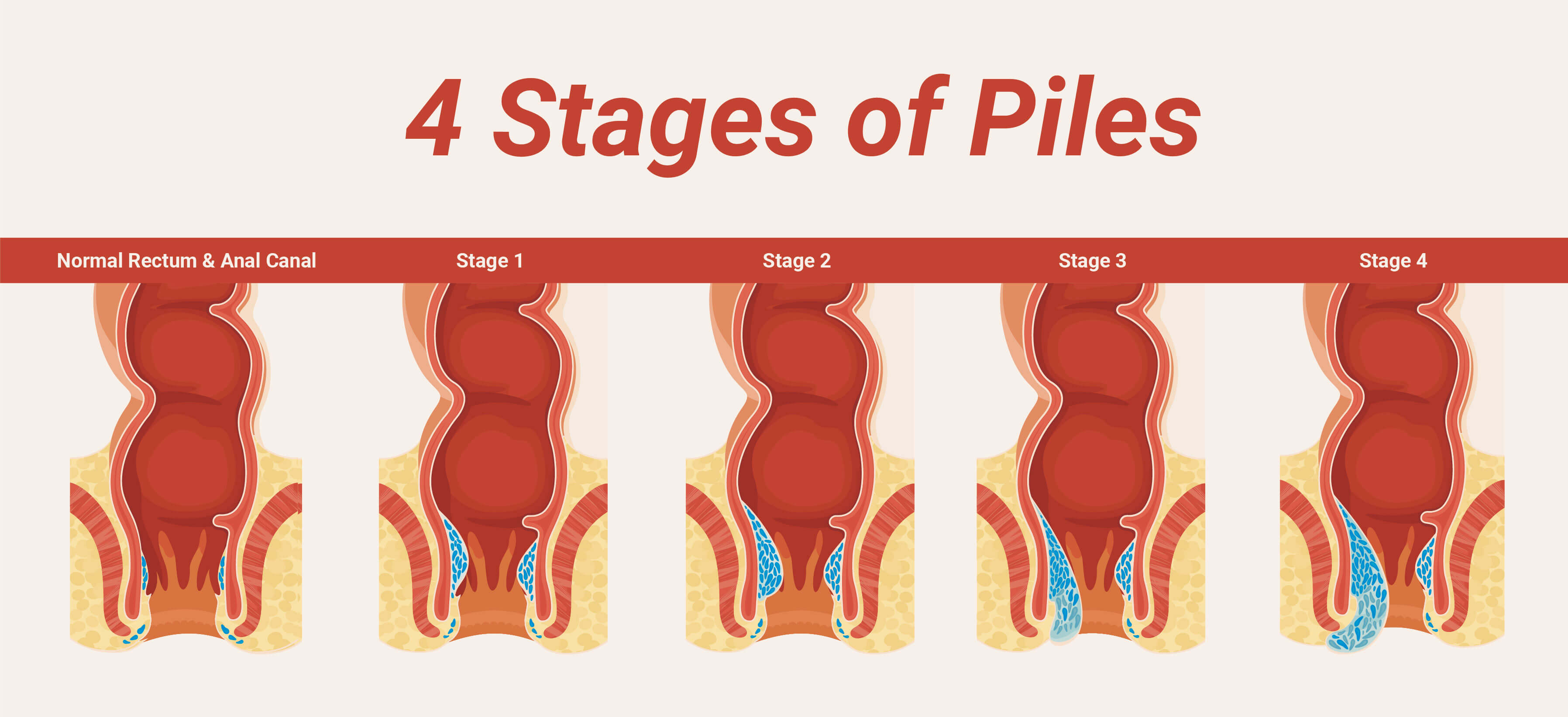 pictorial views of 4 stages of piles