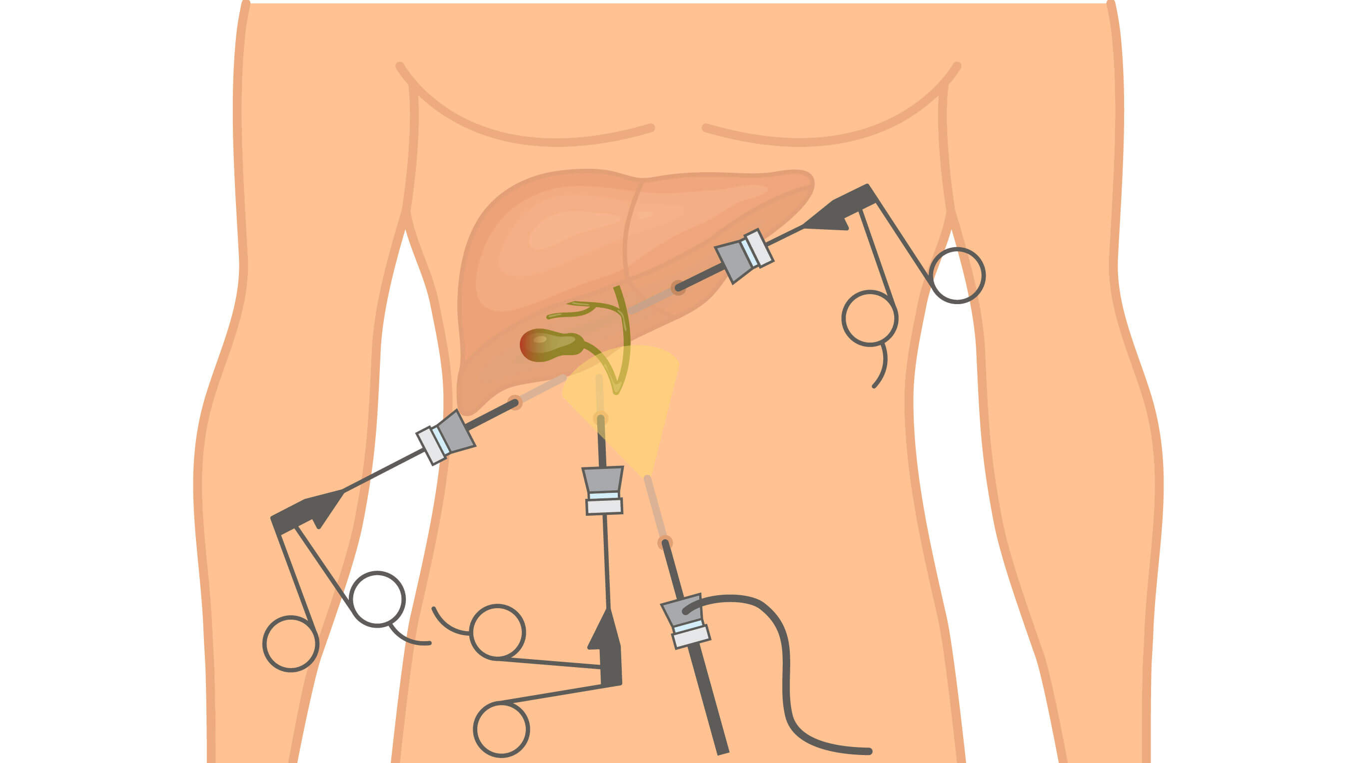 incisions made during Gall Bladder surgery