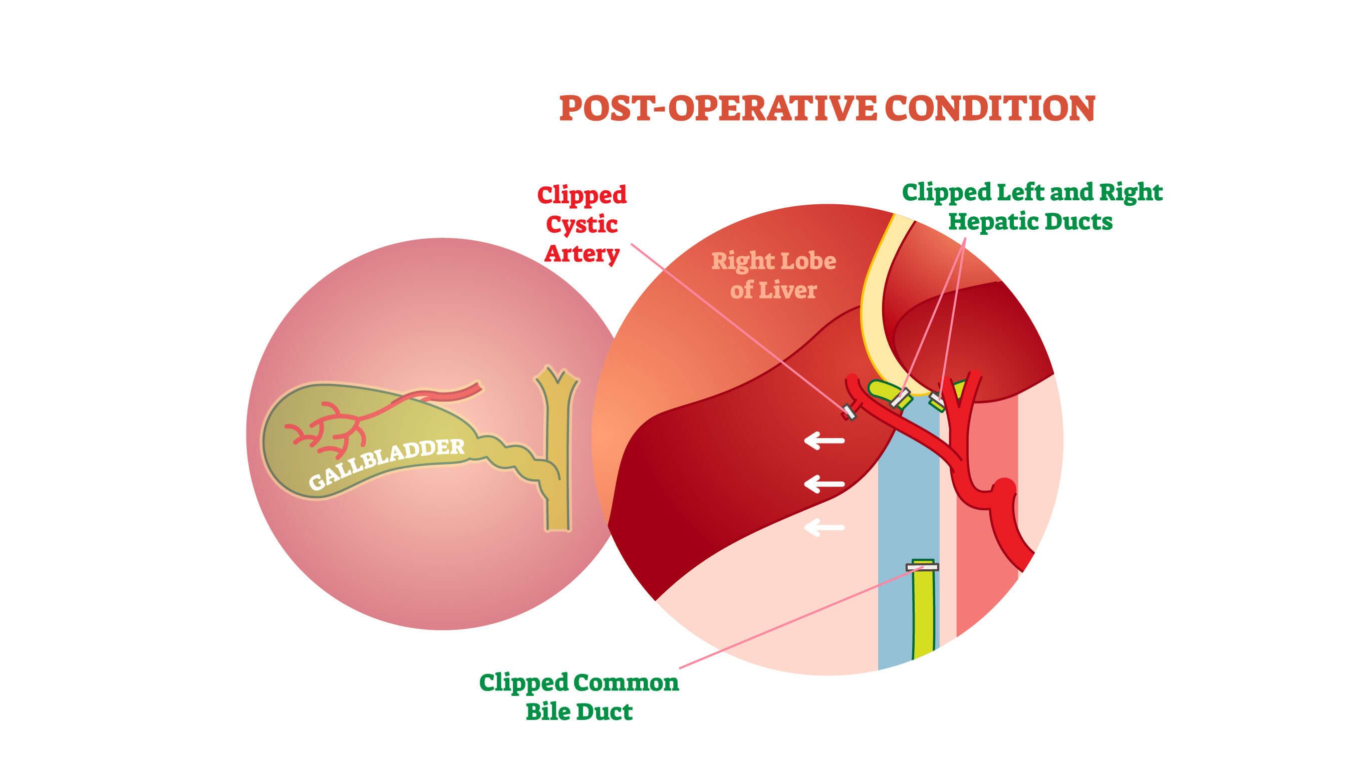 image of post-operative Gall Bladder - 3