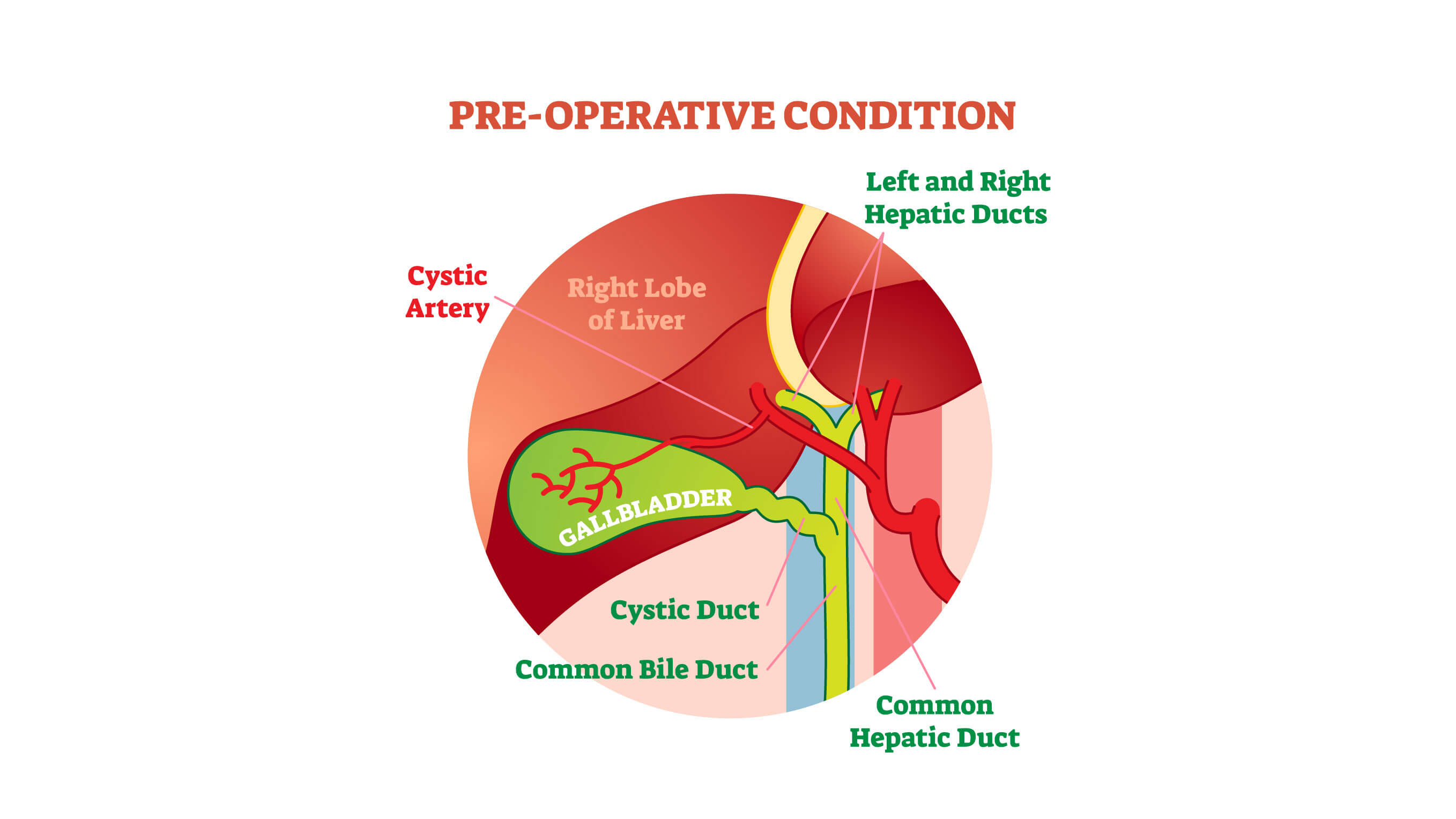 post-operative Gall Bladder