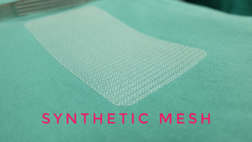 Mesh repair