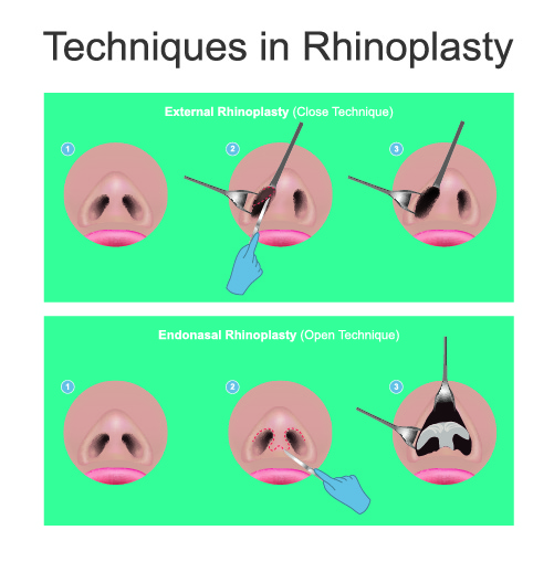 an image showing the procedure involved in the rhinoplasty