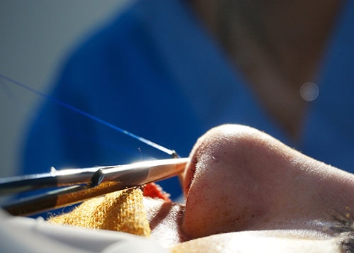 an image showing ongoing nose job procedure