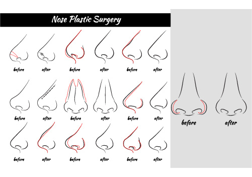 an image showing several nose plastic surgery for different types of nose